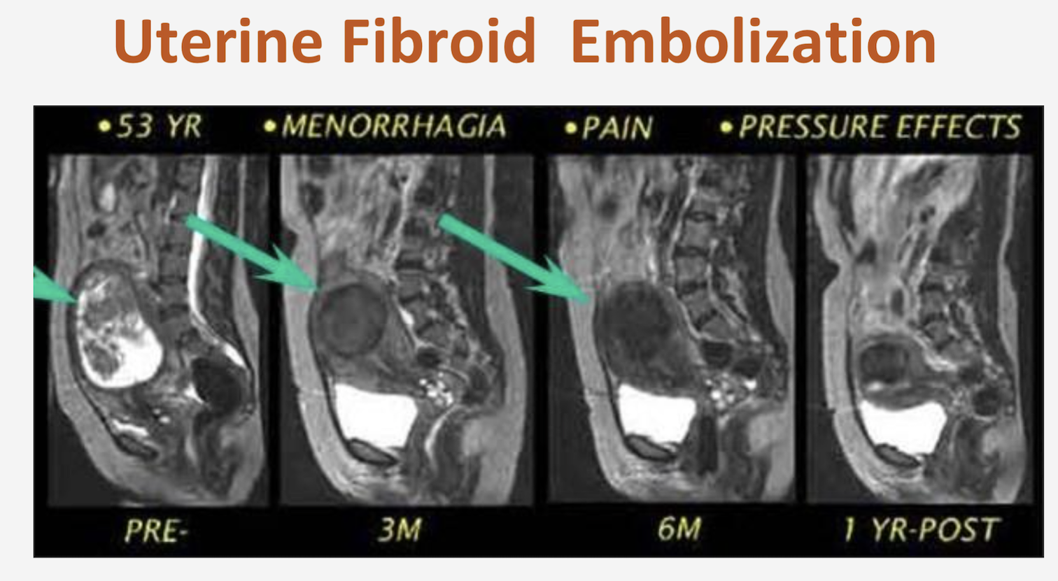 basics-about-uterine-fibroids-and-the-ufe-uterine-fibroid