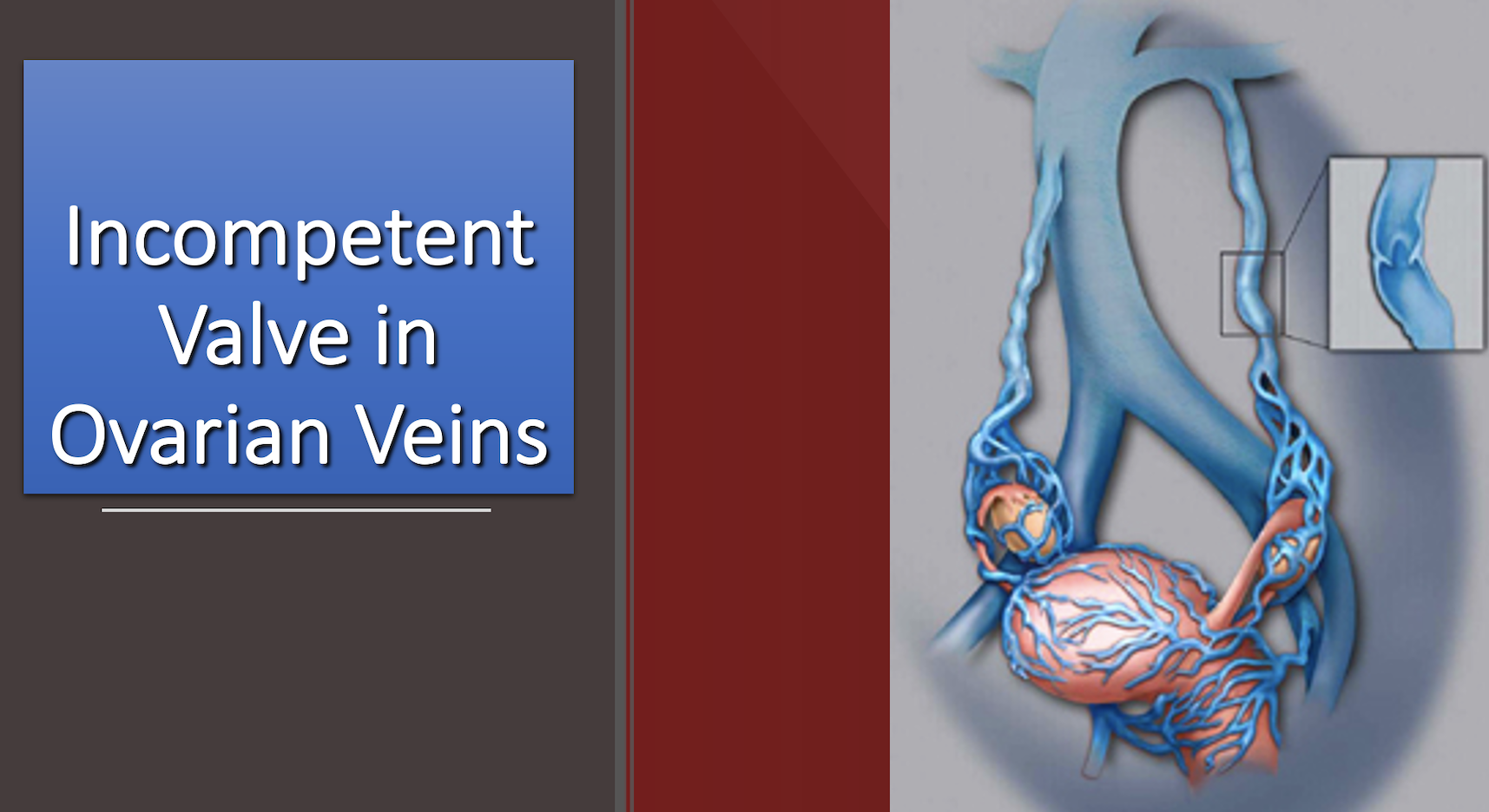 Pelvic Congestion Syndrome Basics for those who want to know more