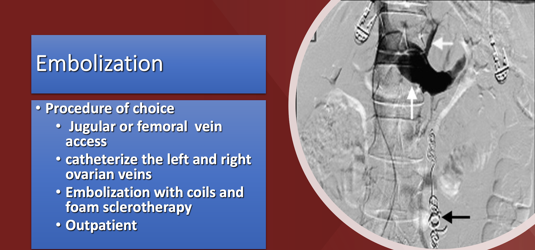 pelvic congestion syndrome presentations by Dr Paramjit "Romi Chopra, MD